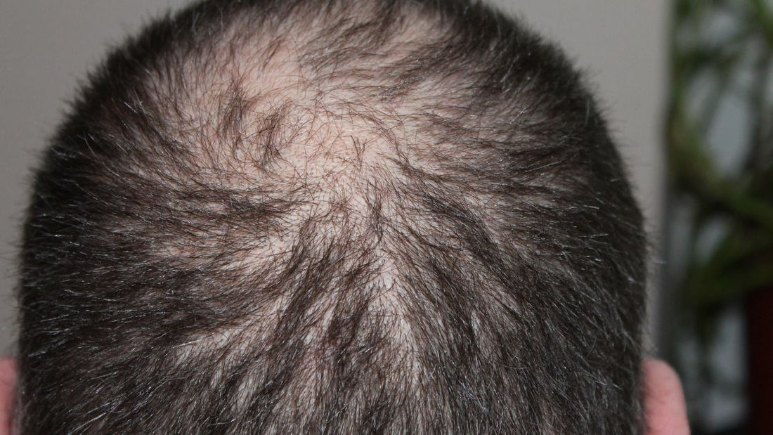 Which Vitamin Deficiency Causes Hair Loss - Know The Facts