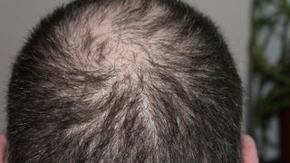 Which Vitamin Deficiency Causes Hair Loss - Know The Facts